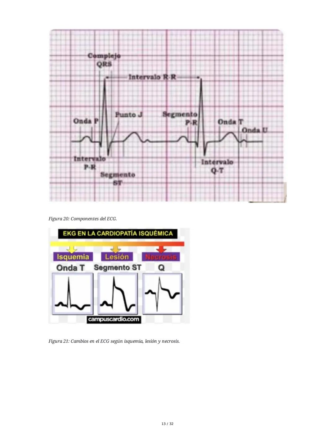 ## Cardiopatía Coronaria

### 1. Introducción y Anatomía de la Circulación Coronaria

La cardiopatía coronaria es una enfermedad crónica del