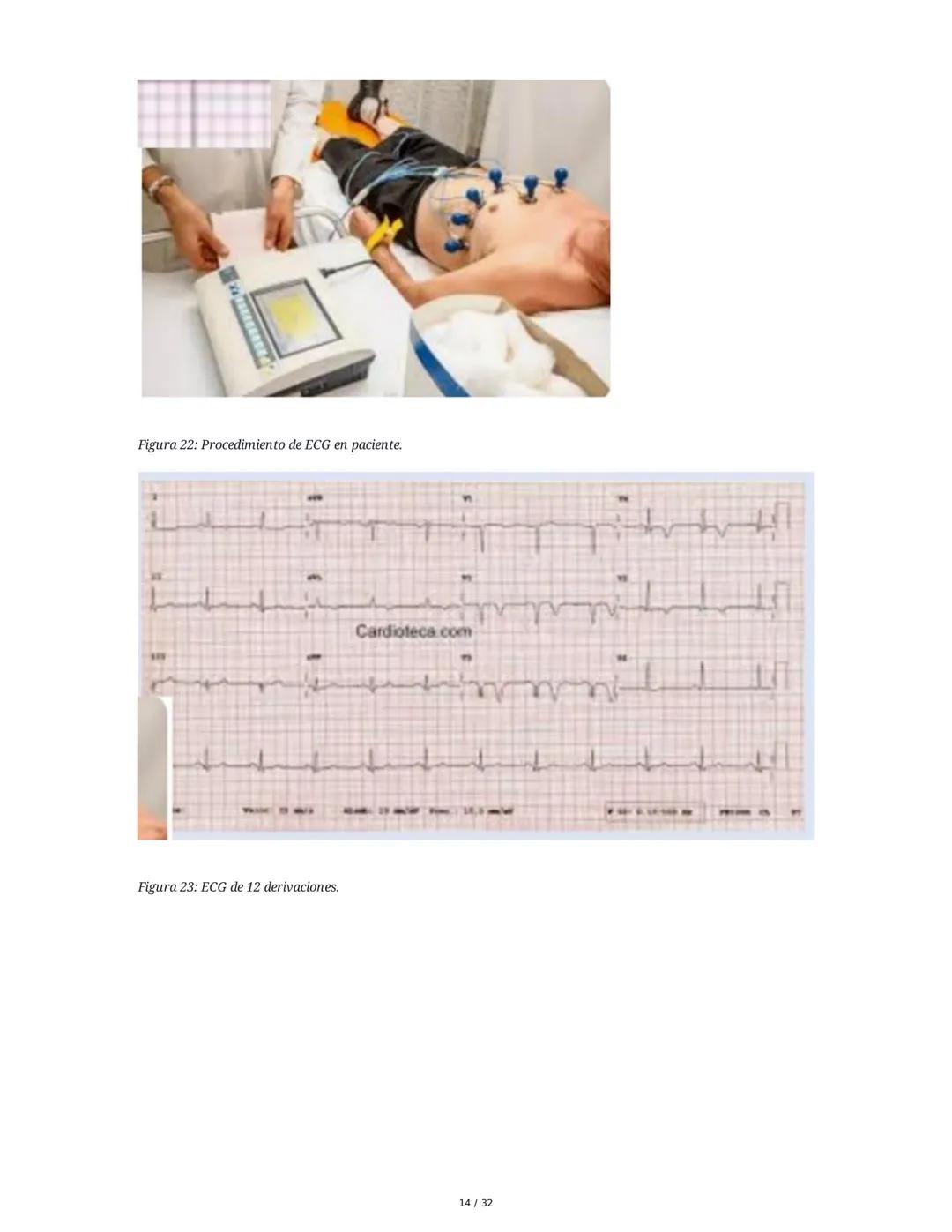 ## Cardiopatía Coronaria

### 1. Introducción y Anatomía de la Circulación Coronaria

La cardiopatía coronaria es una enfermedad crónica del
