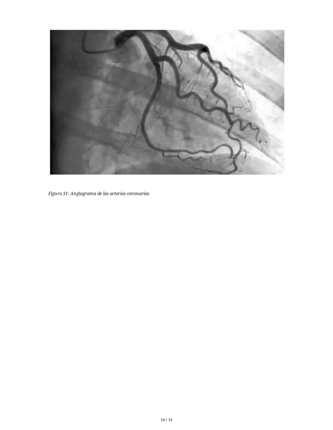 ## Cardiopatía Coronaria

### 1. Introducción y Anatomía de la Circulación Coronaria

La cardiopatía coronaria es una enfermedad crónica del