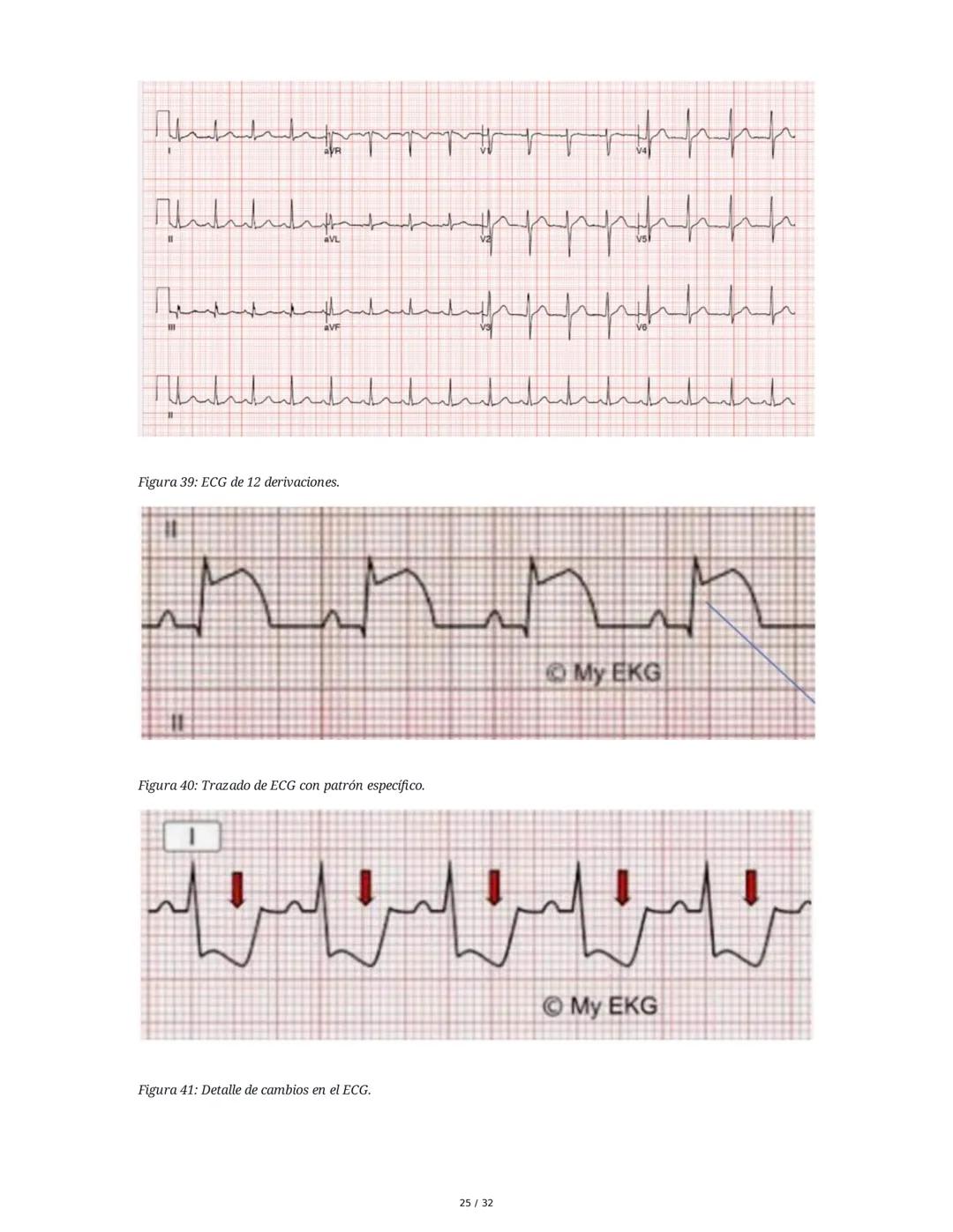 ## Cardiopatía Coronaria

### 1. Introducción y Anatomía de la Circulación Coronaria

La cardiopatía coronaria es una enfermedad crónica del