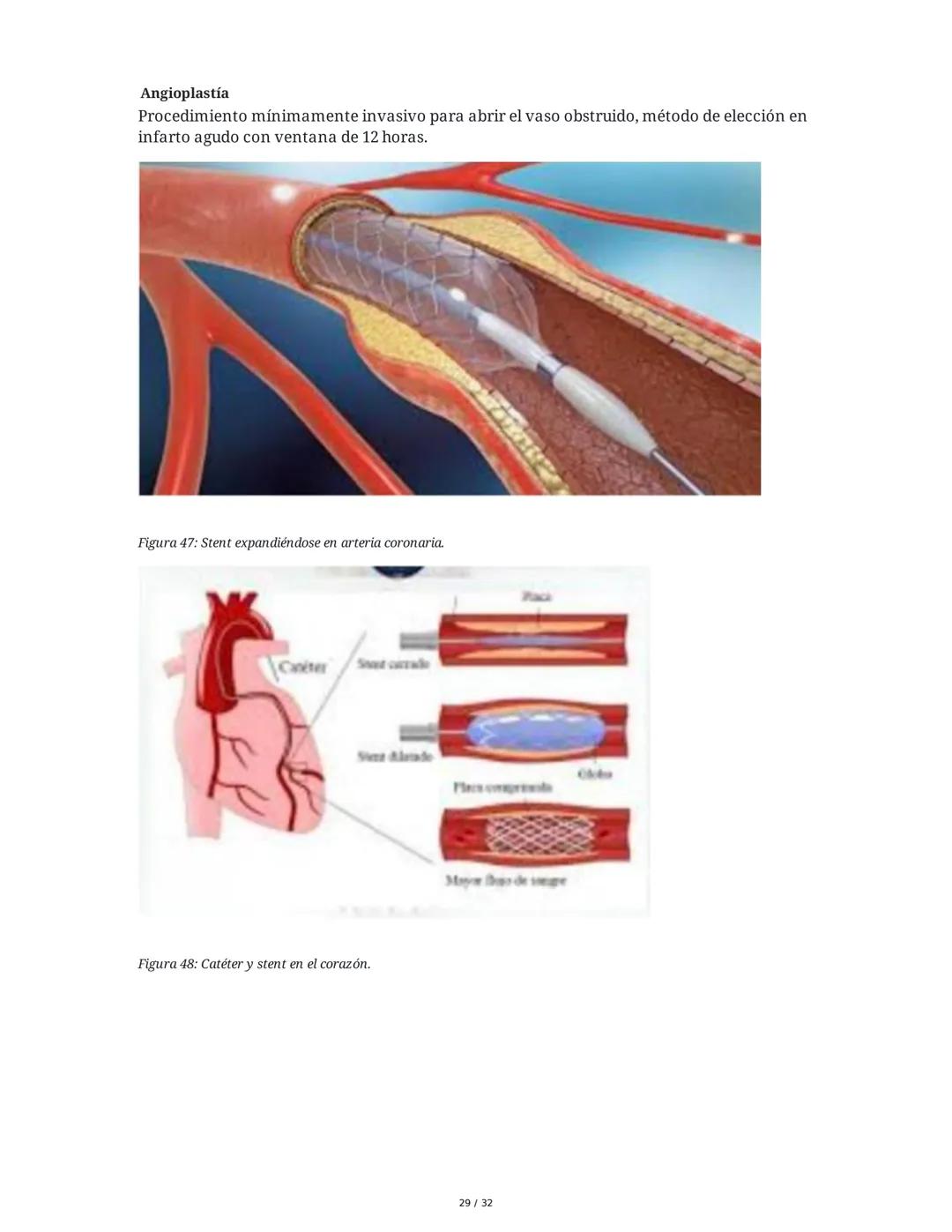 ## Cardiopatía Coronaria

### 1. Introducción y Anatomía de la Circulación Coronaria

La cardiopatía coronaria es una enfermedad crónica del
