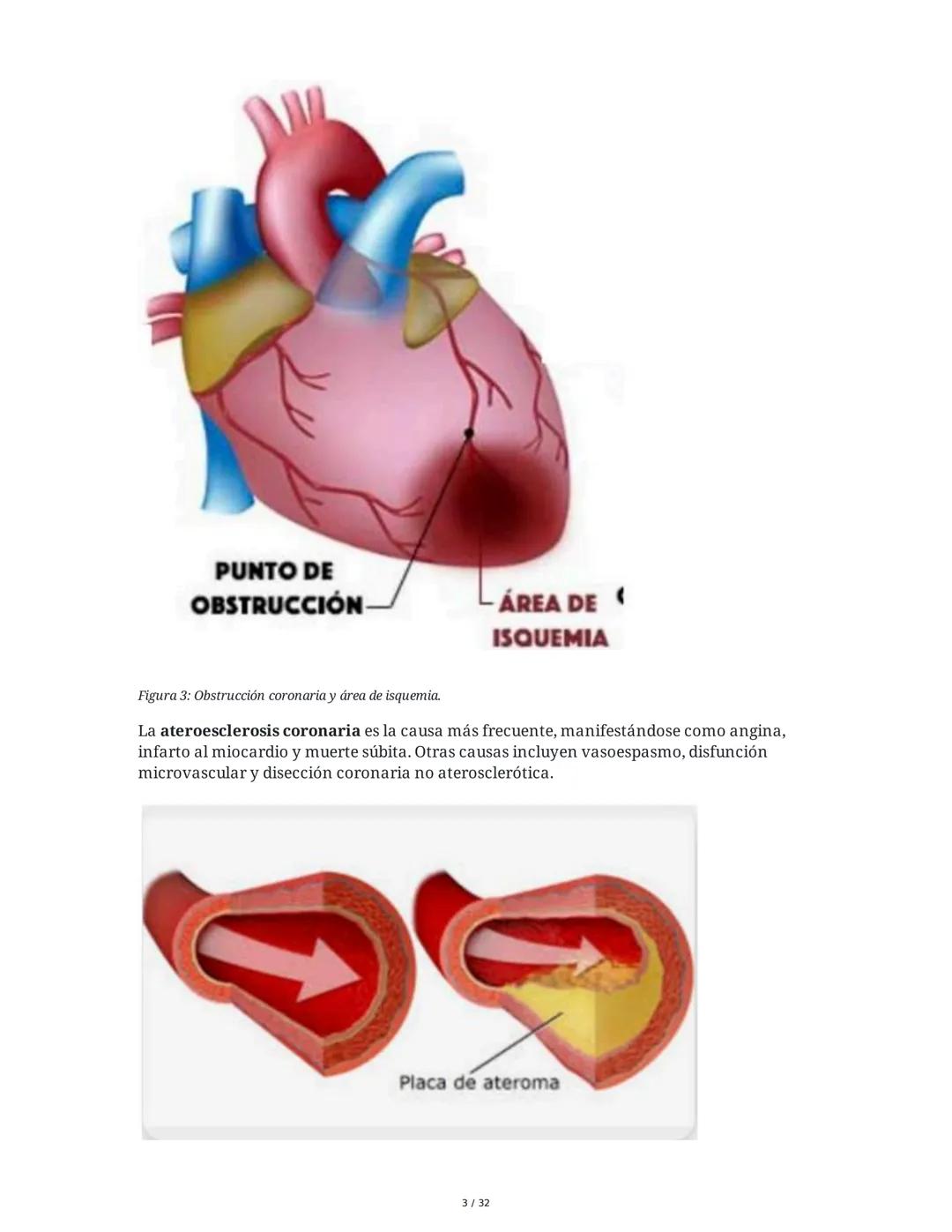 ## Cardiopatía Coronaria

### 1. Introducción y Anatomía de la Circulación Coronaria

La cardiopatía coronaria es una enfermedad crónica del