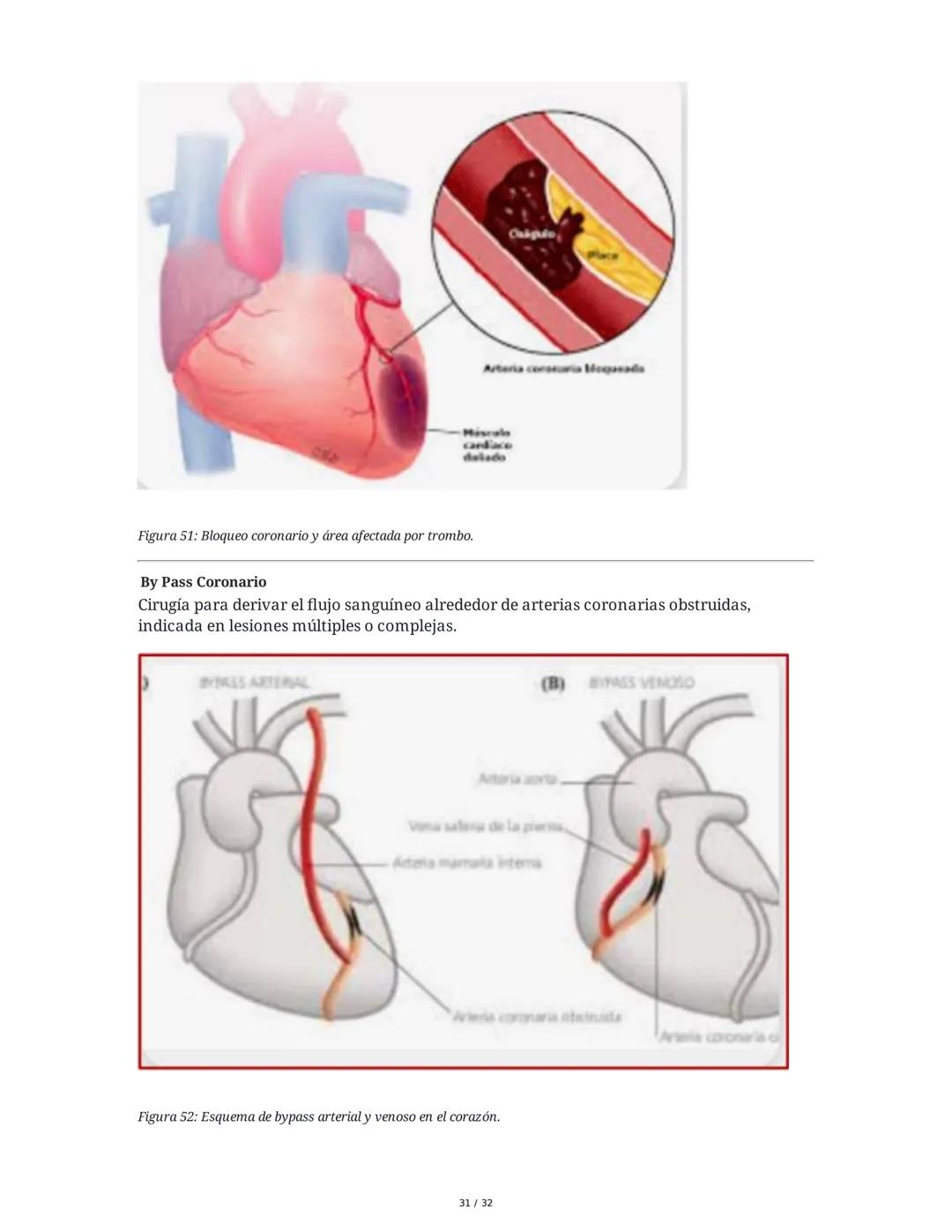 ## Cardiopatía Coronaria

### 1. Introducción y Anatomía de la Circulación Coronaria

La cardiopatía coronaria es una enfermedad crónica del