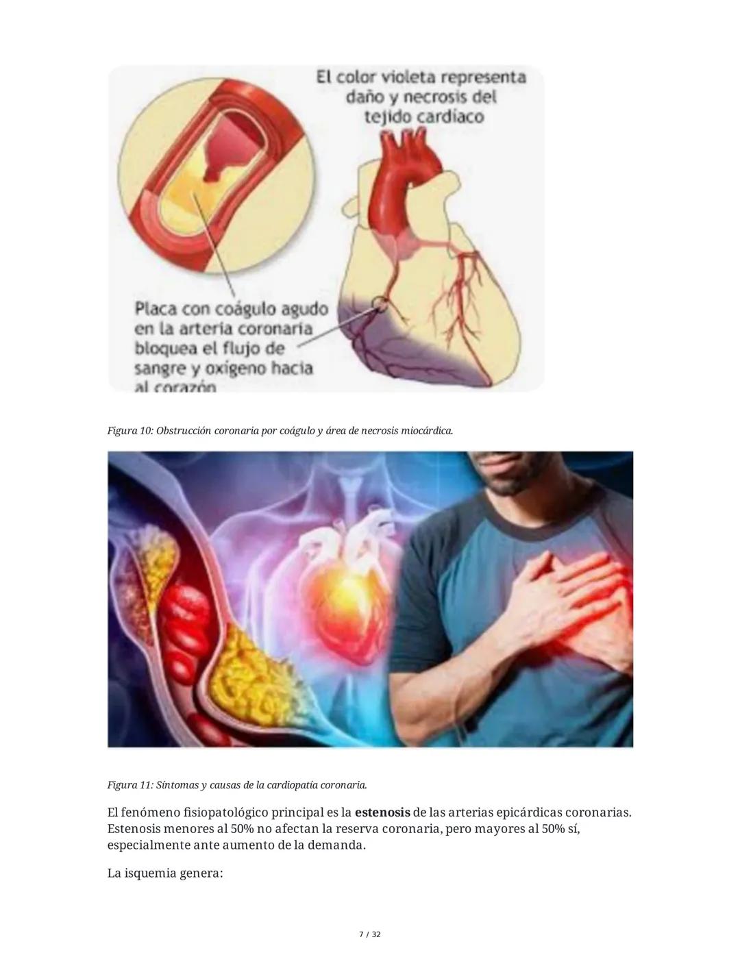## Cardiopatía Coronaria

### 1. Introducción y Anatomía de la Circulación Coronaria

La cardiopatía coronaria es una enfermedad crónica del