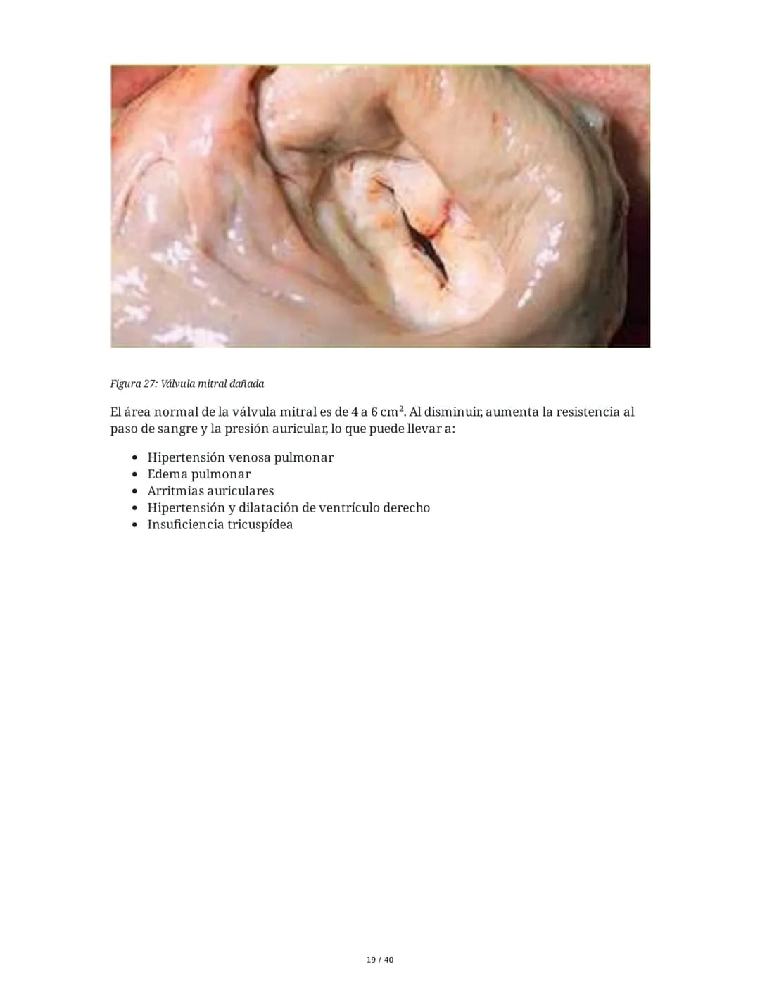 Patologías de las Válvulas Cardiacas
1. Anatomía y Fisiología de las Válvulas Cardiacas
Las válvulas cardíacas son estructuras que permiten 