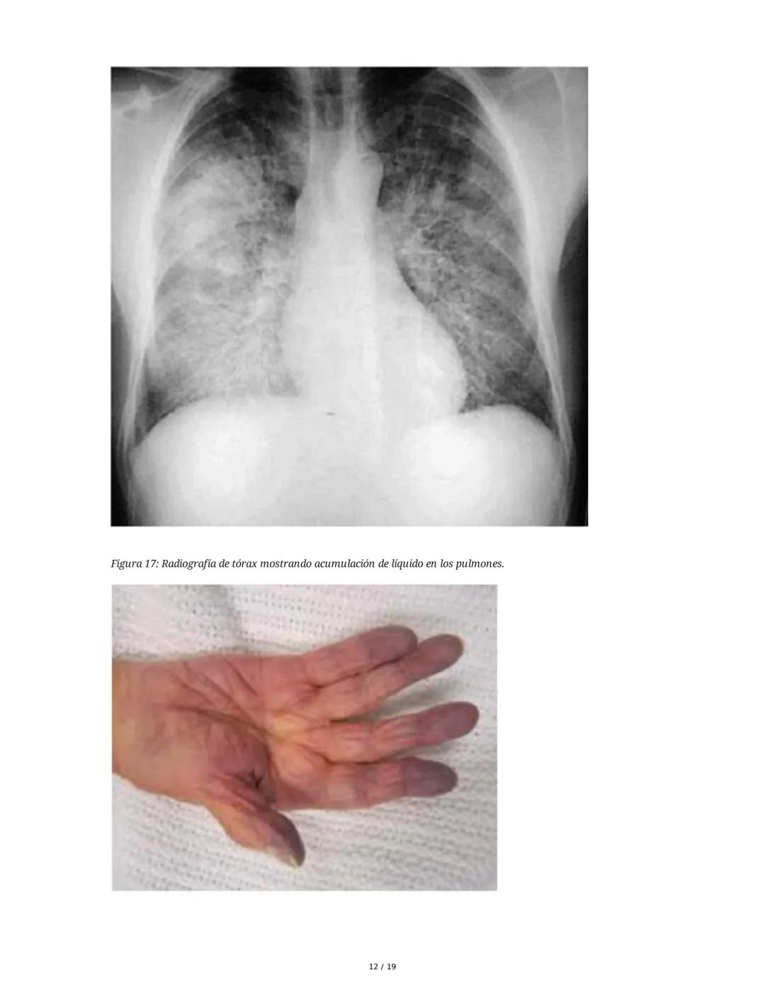 # Insuficiencia Cardiaca

## 1. Introducción y Definición

La insuficiencia cardiaca (IC) es un síndrome clínico complejo y una de las princ