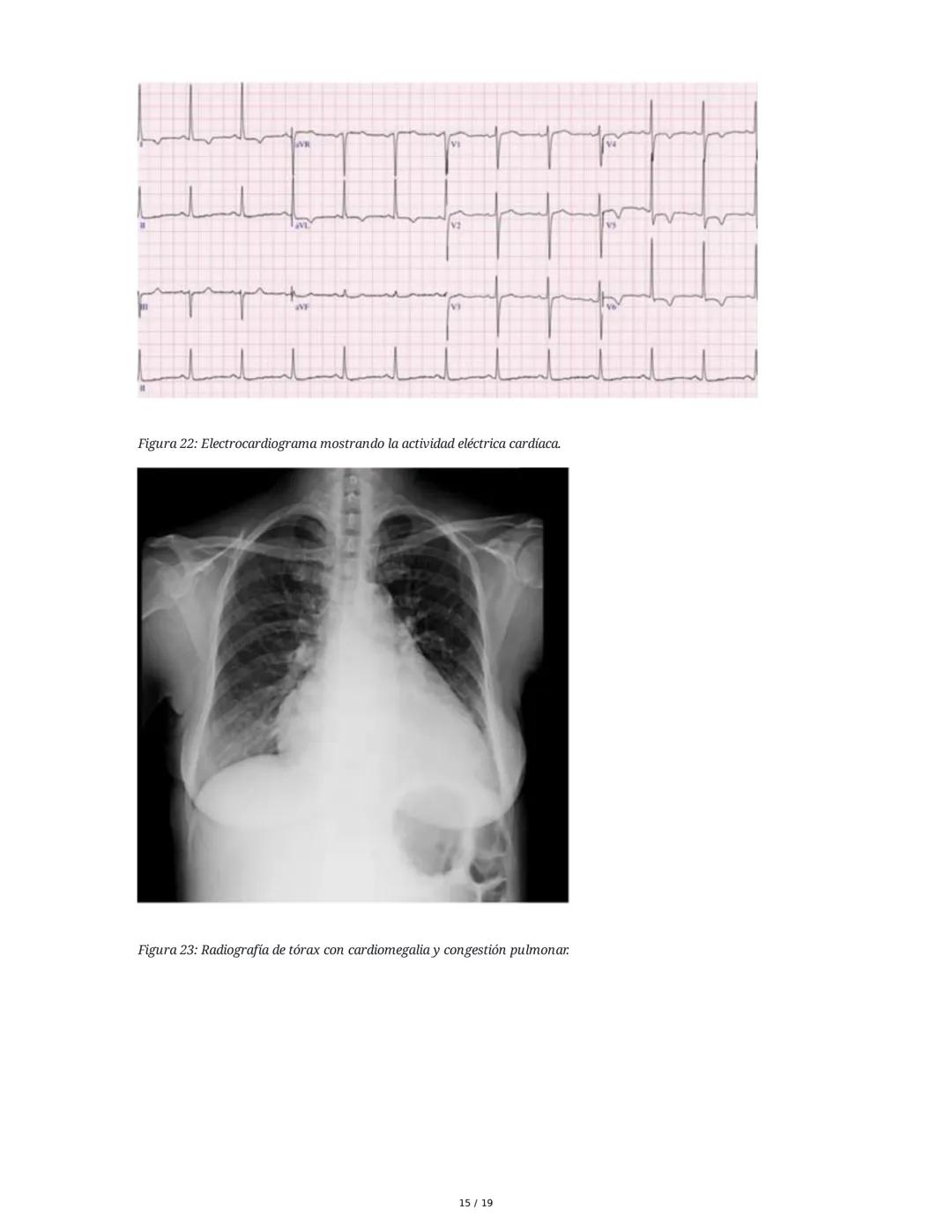 # Insuficiencia Cardiaca

## 1. Introducción y Definición

La insuficiencia cardiaca (IC) es un síndrome clínico complejo y una de las princ