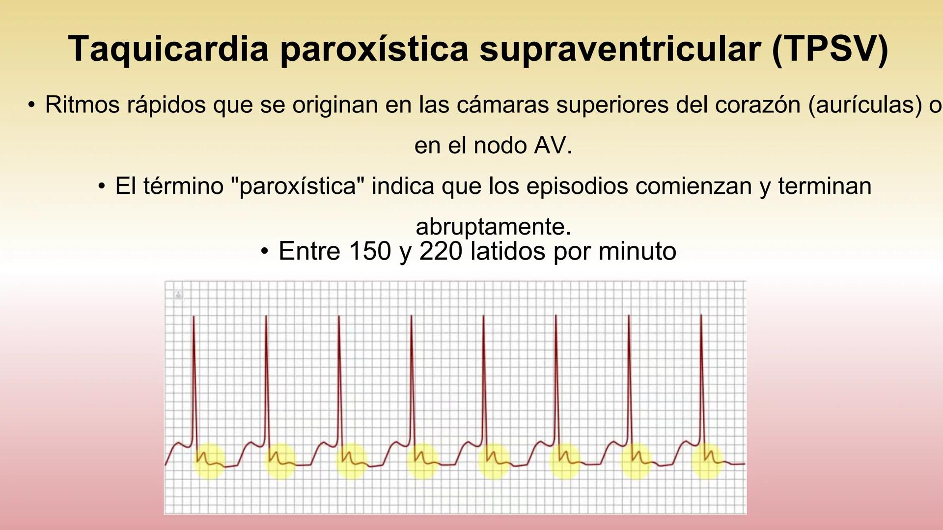 # ARRITMIAS # DEFINICIÓN
- Trastornos del ritmo cardíaco
- Problemas con la frecuencia o el ritmo de los latidos
del corazón.
- Esto sucede