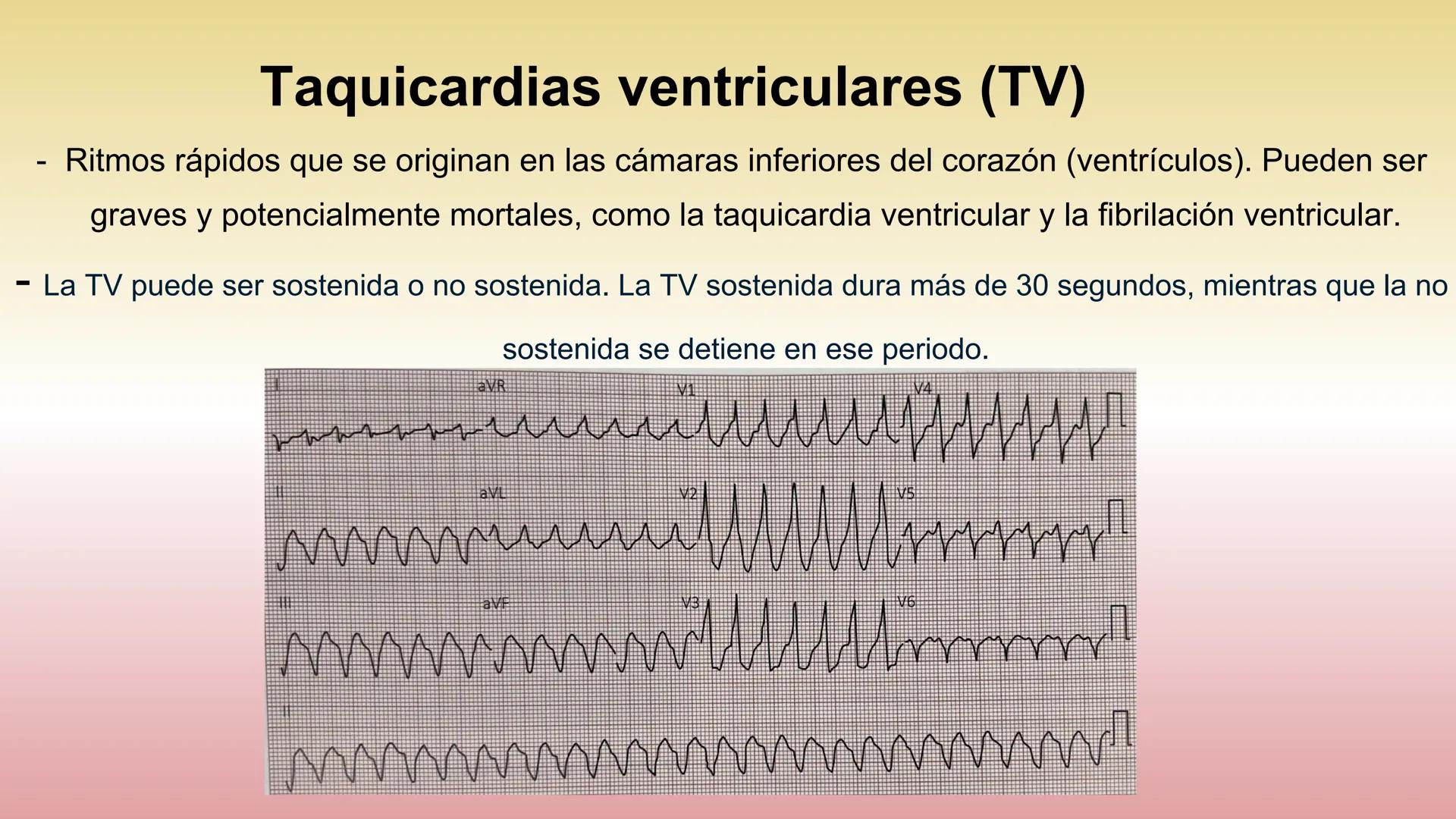 # ARRITMIAS # DEFINICIÓN
- Trastornos del ritmo cardíaco
- Problemas con la frecuencia o el ritmo de los latidos
del corazón.
- Esto sucede