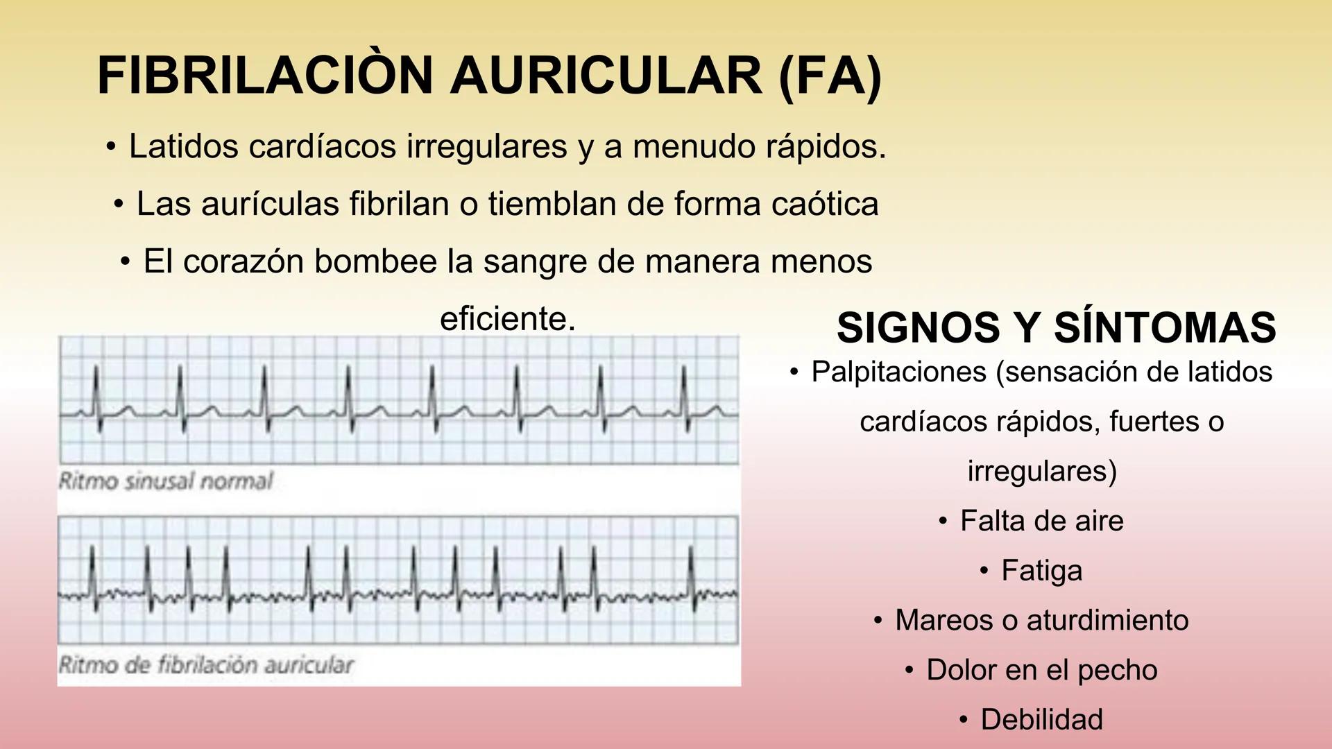 # ARRITMIAS # DEFINICIÓN
- Trastornos del ritmo cardíaco
- Problemas con la frecuencia o el ritmo de los latidos
del corazón.
- Esto sucede